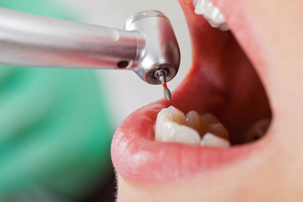 Best Emergency Root Canal Treatment in Mount Juliet, TN